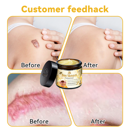 🏵️𝑇𝑢𝑟𝑜𝑛𝑢™ Bee Venom Skin Treatment Cream（𝐴𝐴𝐷 𝑅𝑒𝑐𝑜𝑚𝑚𝑒𝑛𝑑𝑒𝑑）