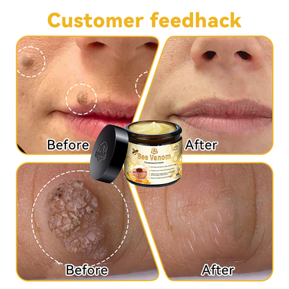 🏵️𝑇𝑢𝑟𝑜𝑛𝑢™ Bee Venom Skin Treatment Cream（𝐴𝐴𝐷 𝑅𝑒𝑐𝑜𝑚𝑚𝑒𝑛𝑑𝑒𝑑）